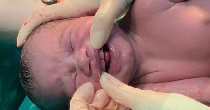Vídeo: Bebê nasce com seis dentinhos e surpreende equipe médica no Mato Grosso do Sul