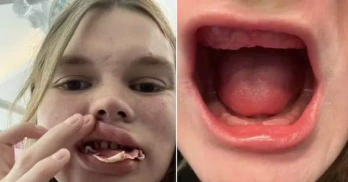 Tratamento dentário barato faz mulher perder todos os dentes; saiba o que aconteceu!